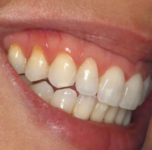 Proteja a raiz do dente para evitar mais problemas