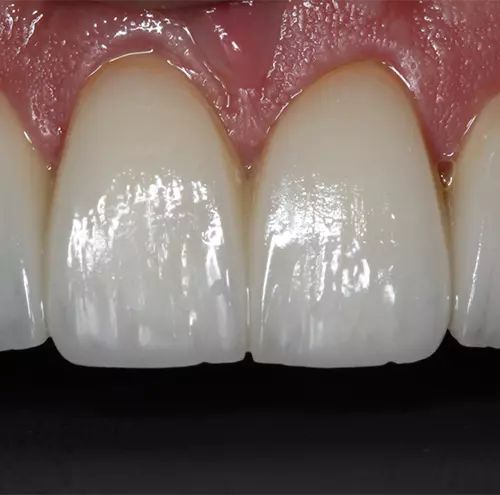 Lente de Contato Dental para um sorriso transformado 