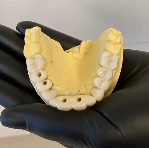 Próteses Dentárias para todas as necessidades