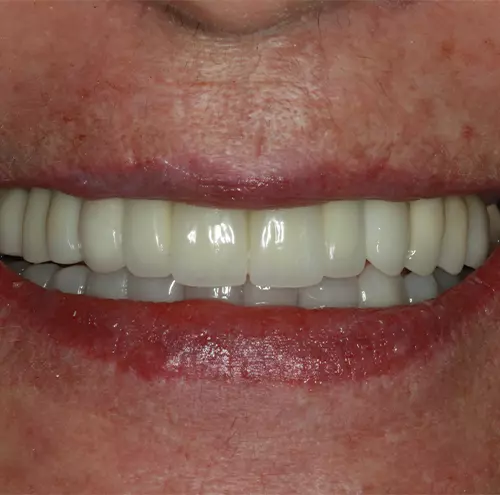 A melhor prótese dentária em Brasília você encontra na Clínica Dirce Nascimento Odontologia